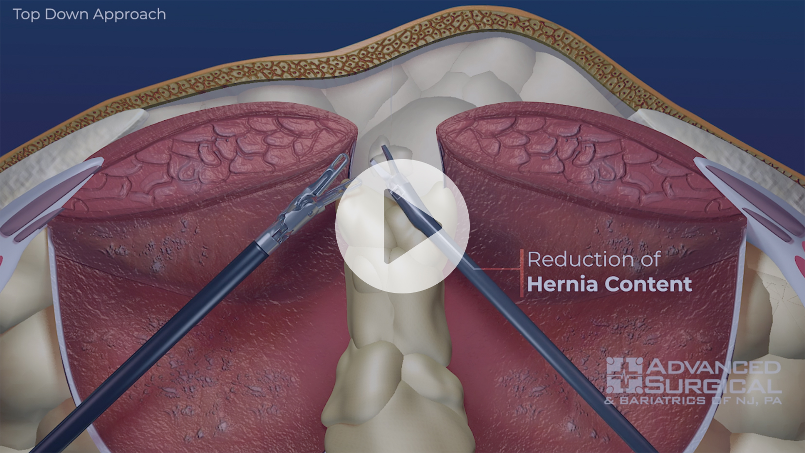 Incisional Hernia Advanced Surgical & Bariatrics of NJ